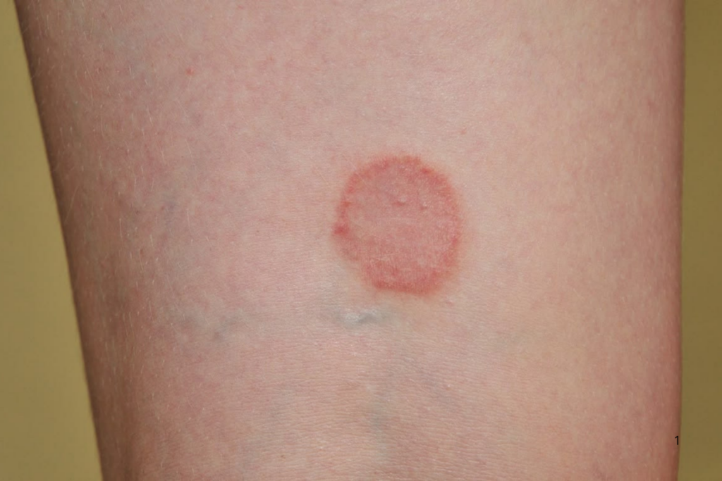 SURTO: Fungo Altamente Contagioso e Transmitido por Via Sexual Acende Alerta Epidemiológico Internacional