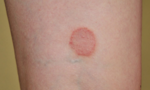 SURTO: Fungo Altamente Contagioso e Transmitido por Via Sexual Acende Alerta Epidemiológico Internacional