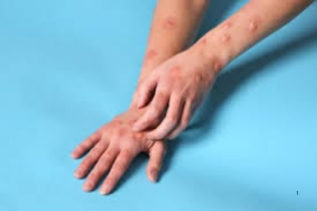 ALERTA: Rio Branco Registra Caso Suspeito de Mpox; Paciente está em Isolamento e Resultado Sai até Quarta-Feira