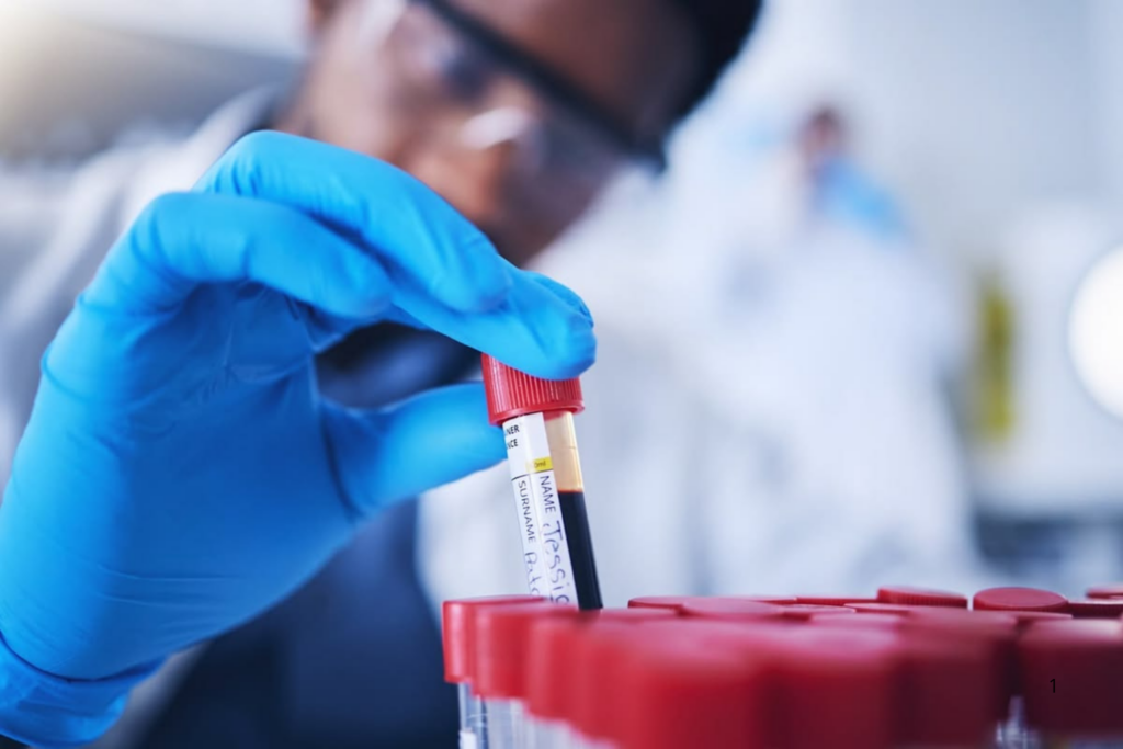 DIAGNÓSTICO: Exame de Sangue pode Detectar Tumor Cerebral com Mais de 90% de Precisão, Dizem Cientistas